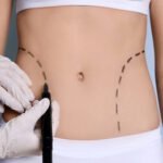 Liposuction: Advanced Body Contouring for Targeted Fat Reduction