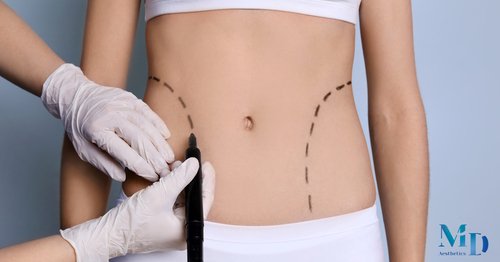 Liposuction: Advanced Body Contouring for Targeted Fat Reduction